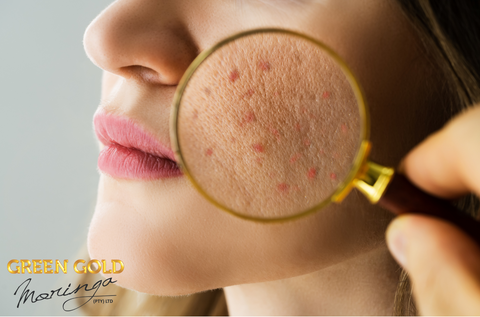 Transform Your Skincare Routine with Green Gold Moringa: Say Goodbye to Acne!